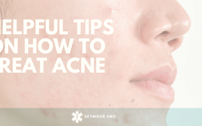 6 helpful tips on how to Treat Acne