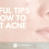 6 helpful tips on how to Treat Acne