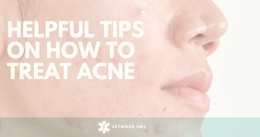 6 helpful tips on how to Treat Acne